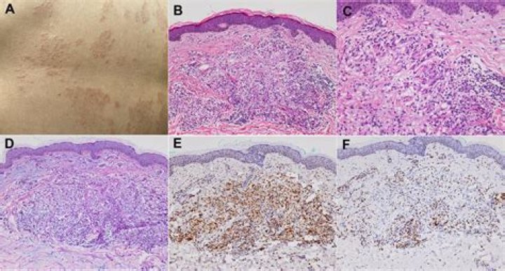 Diffuse Mildly Erythematous Mucosa Unraveled