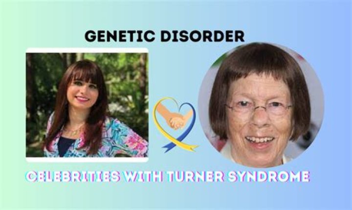 Unveiling The Extraordinary: Actors With Turner Syndrome